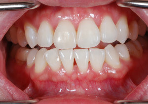 After tooth bleaching