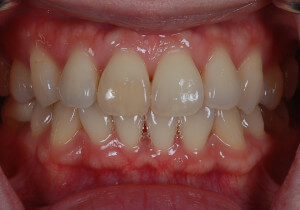 Before tooth bleaching
