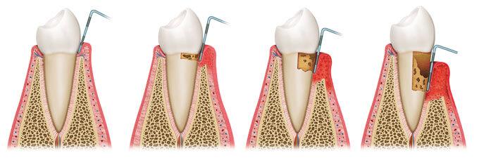 periodontitis