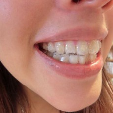 隱形矯正是不是適合每一個人呢？　隱形矯正的適應症介紹