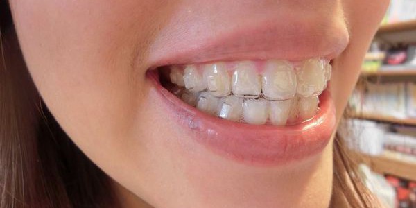 隱形矯正是不是適合每一個人呢? 隱形矯正的適應症介紹 隱形矯正是不是適合每一個人呢? 隱形矯正的適應症介紹