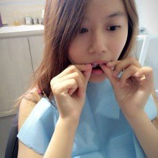 隱形矯正分享 修牙縫篇