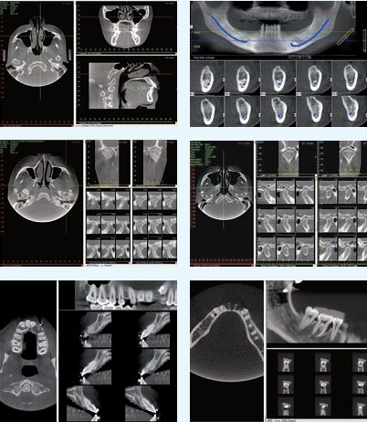 我要不要補骨補肉? 植牙前的缺牙區評估