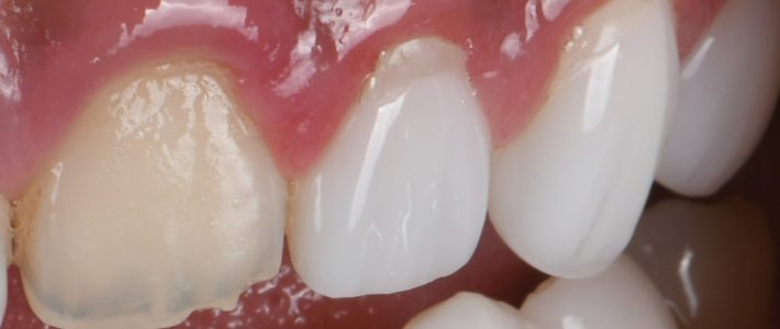 藍瓷琥珀瓷有差別嗎?為什麼妳不該去上海做陶瓷貼片 藍瓷琥珀瓷有差別嗎?為什麼妳不該去上海做陶瓷貼片