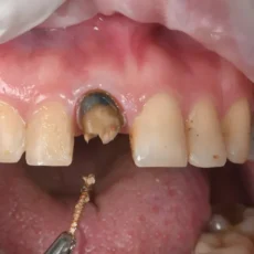 案例005|大範圍蛀牙，顏色不均的前牙美學處理