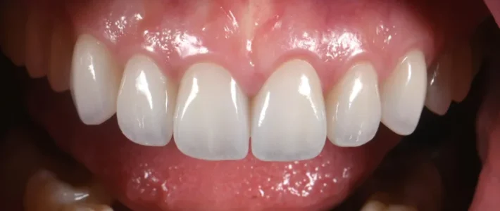 案例004|笑齦,蛀牙,微笑曲線歪斜改善 案例004|笑齦,蛀牙,微笑曲線歪斜改善