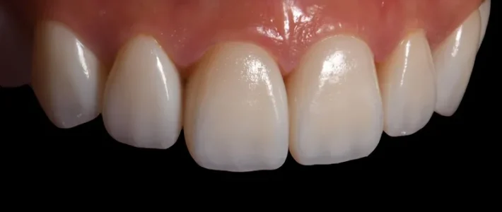 案例003|矯正後藉由陶瓷貼片改善微笑曲線 案例003|矯正後藉由陶瓷貼片改善微笑曲線