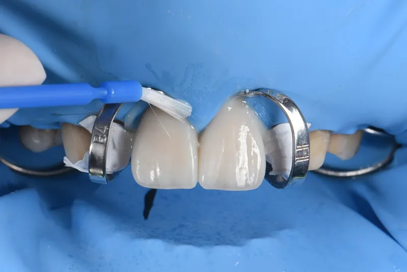 陶瓷貼片黏結過程