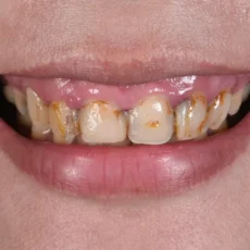 案例001｜笑齦、大範圍蛀牙的修復與重建流程