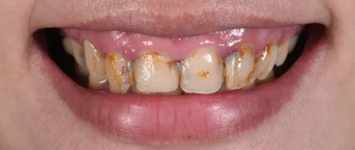 案例001|笑齦、大範圍蛀牙的修復與重建流程 案例001|笑齦、大範圍蛀牙的修復與重建流程