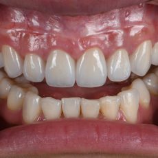 案例007|骨暴笑齦與大範圍蛀牙的美學處裡