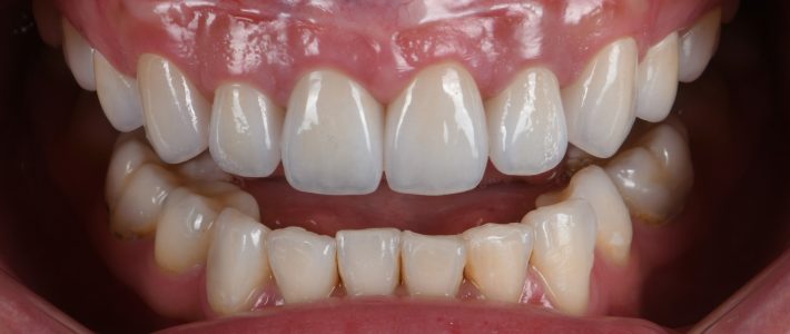 案例007|骨暴笑齦與大範圍蛀牙的美學處裡 案例007|骨暴笑齦與大範圍蛀牙的美學處裡