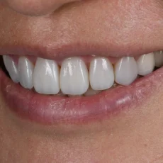 案例006|舊陶瓷貼片更換與隱適美微調