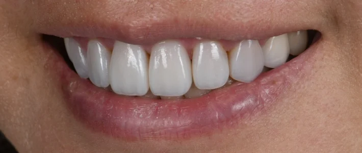 案例006|舊陶瓷貼片更換與隱適美微調