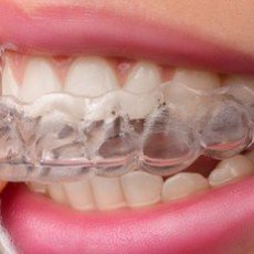 隱形矯正可以不用拔牙？談談隱形矯正3種創造空間的方法