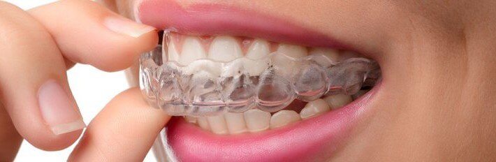 隱形矯正可以不用拔牙?談談隱形矯正3種創造空間的方法 隱形矯正可以不用拔牙?談談隱形矯正3種創造空間的方法