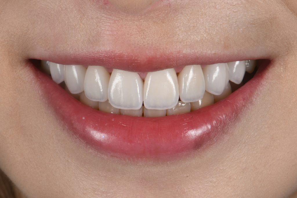 四環黴素牙齒利用陶瓷貼片改善顏色的術後照片