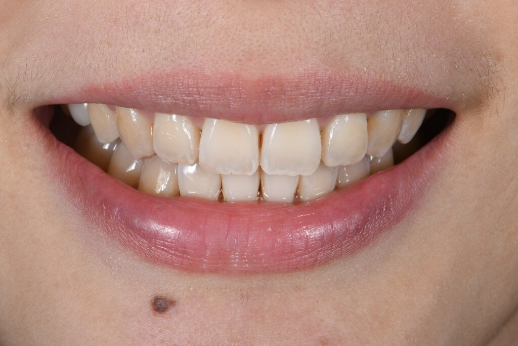 矯正後正面笑容圖