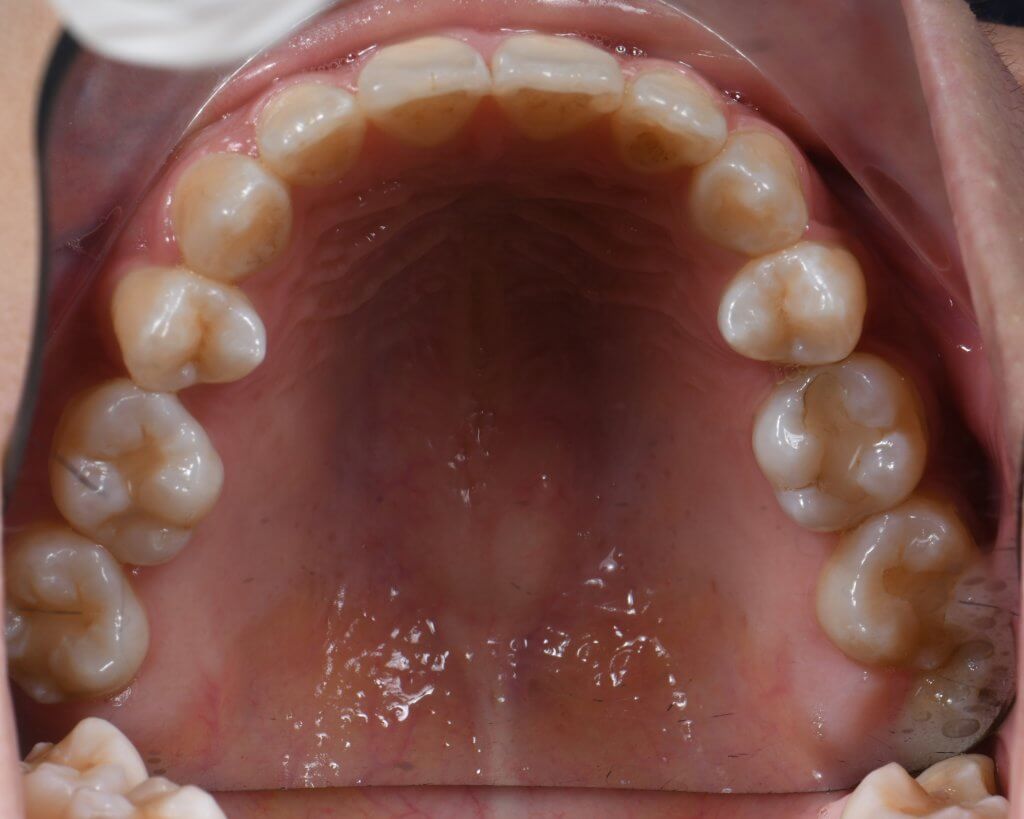 矯正後上顎咬合面圖