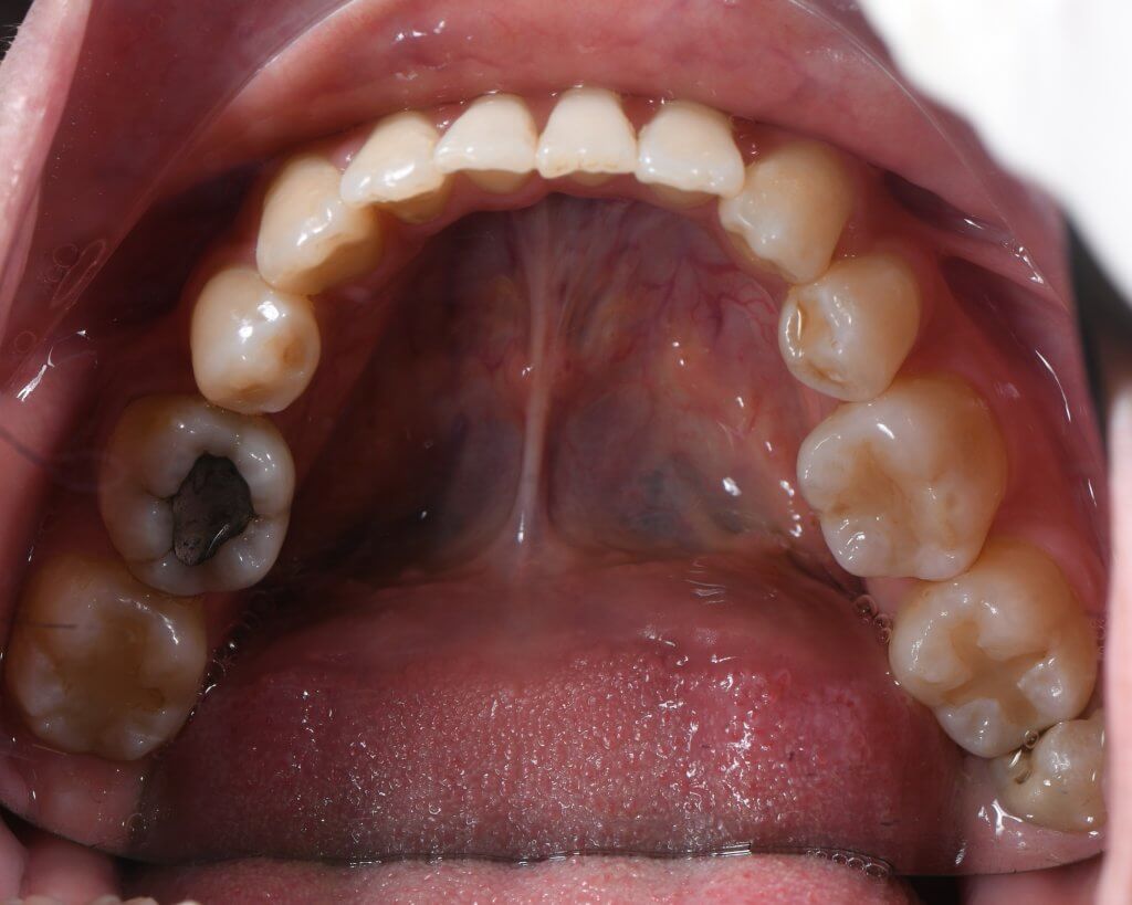 矯正後下顎咬合面圖