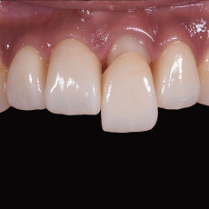 門牙樹脂補牙染色與蛀牙後的貼片重建