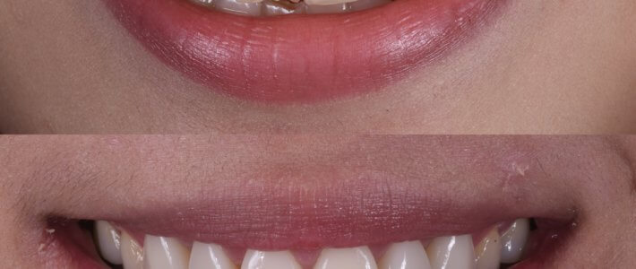 笑起來總是露牙齦！笑齦的原因、診斷與治療分享