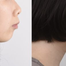 如何知道暴牙矯正的效果好不好？齒性與骨性暴牙的區分與矯正。