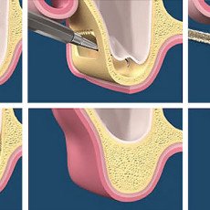 鼻竇增高術是什麼? 手術方式、術前評估與術後注意事項介紹