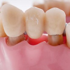 植牙會比做假牙好嗎? 關於選擇固定式牙橋或人工植牙的幾個建議