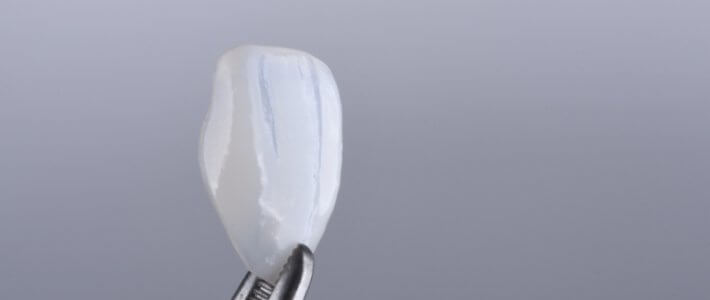 陶瓷貼片容易壞嗎?牙齒會不會敏感?十個瓷牙貼片常見問題與解答 陶瓷貼片容易壞嗎?牙齒會不會敏感?十個瓷牙貼片常見問題與解答