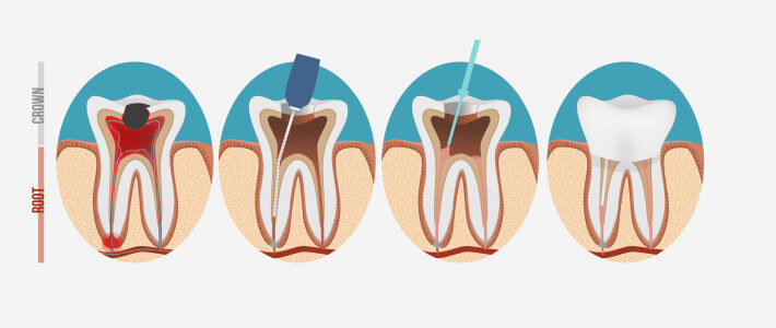 Endodontic treatment