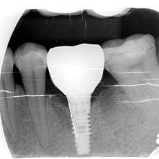 植牙前該知道的兩三事－我有糖尿病適合植牙嗎？人工植牙治療的禁忌症介紹