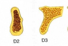 如何植牙補骨？淺談引導式骨再生術，骨粉種類與再生膜介紹