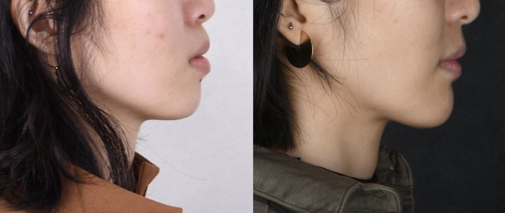 傳統矯正-改善骨性暴牙,下排齒列不整齊 傳統矯正-改善骨性暴牙,下排齒列不整齊