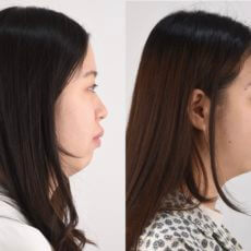 大部分的開咬是不需要動手術的，開咬的成因與矯正案例介紹　