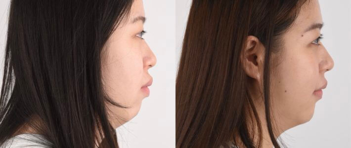 大部分的開咬是不需要動手術的,開咬的成因與矯正案例介紹  大部分的開咬是不需要動手術的,開咬的成因與矯正案例介紹