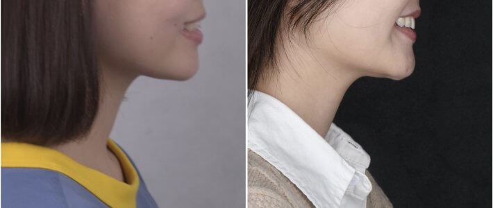 傳統矯正-門牙不整齊,側門牙內凹,中線偏的案例分享 傳統矯正-門牙不整齊,側門牙內凹,中線偏的案例分享