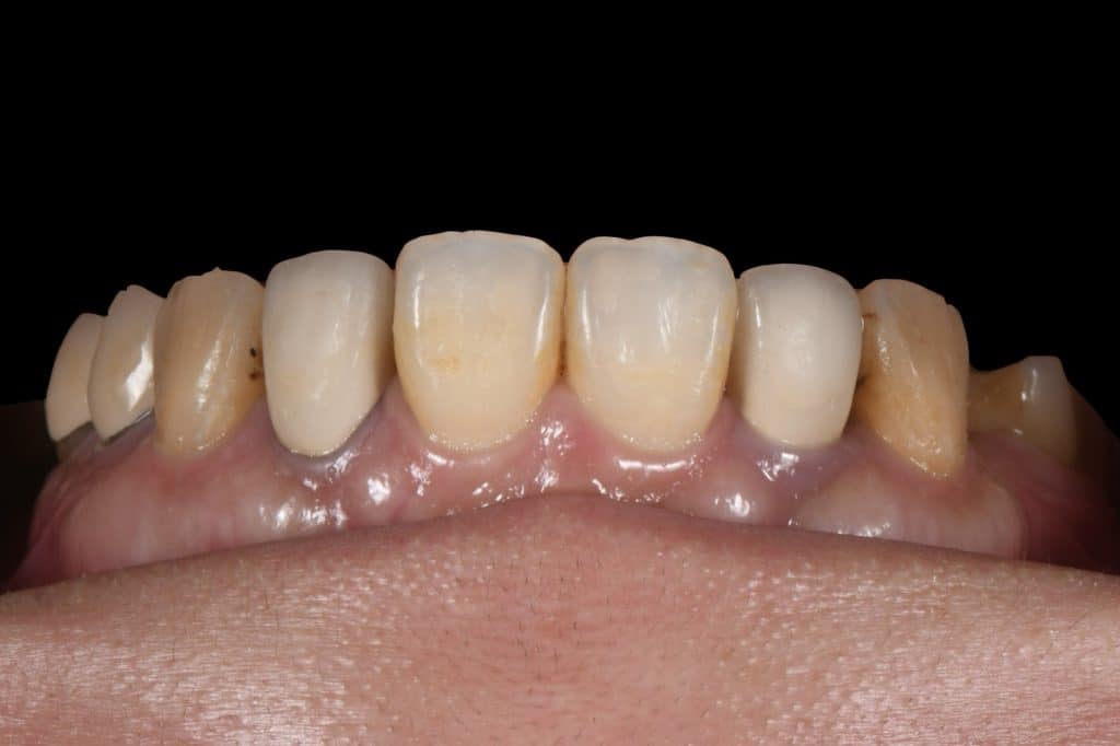 假牙未拆除的正面口內照