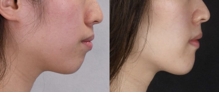 傳統矯正-改善骨性暴牙、深咬、笑齦 傳統矯正-改善骨性暴牙、深咬、笑齦