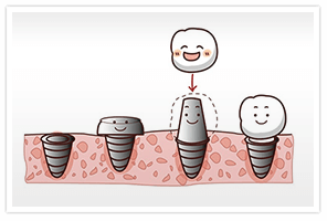 植牙流程、時機、注意事項與維護介紹