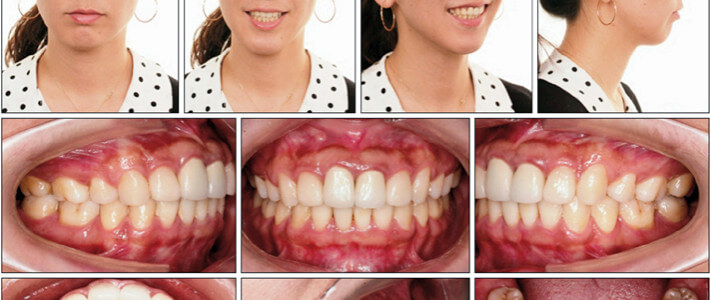 深咬、暴牙與長臉型的矯正,利用骨釘達到改善臉型的效果 深咬、暴牙與長臉型的矯正,利用骨釘達到改善臉型的效果