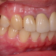 門牙牙套失敗後的植牙重建