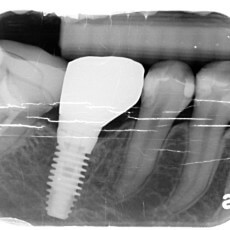 下顎第一大臼齒拔牙同時合併人工植牙