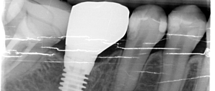 下顎第一大臼齒拔牙同時合併人工植牙 下顎第一大臼齒拔牙同時合併人工植牙