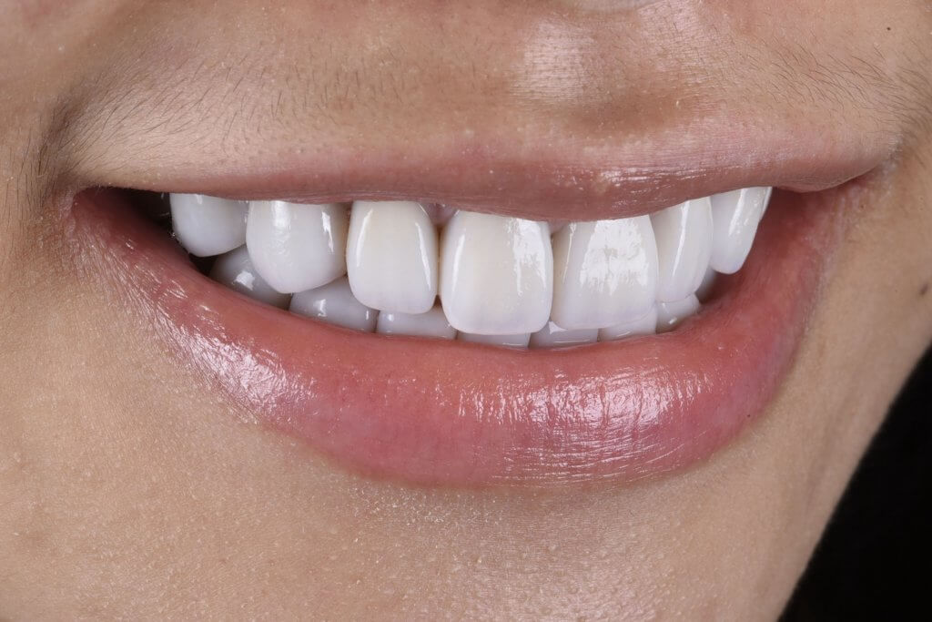 四環黴素染色牙用陶瓷貼片遮色後的側面笑容