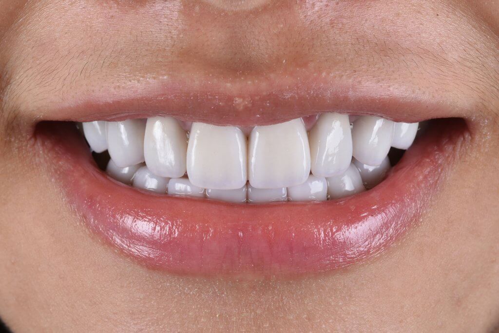 四環黴素染色牙用陶瓷貼片遮色後的笑容