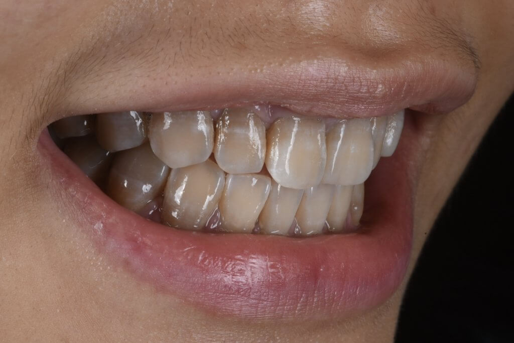 四環黴素染色牙的側面照