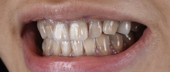 四環黴素牙美白有用嗎?染色成因與陶瓷貼片優缺點比較 四環黴素牙美白有用嗎?染色成因與陶瓷貼片優缺點比較