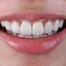 你適合隱適美嗎? 醫師判斷的四個標準與圖文解說