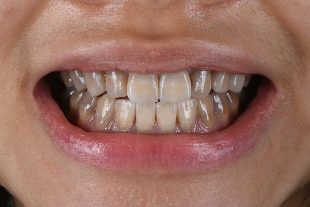 四環黴素染色牙的正面照